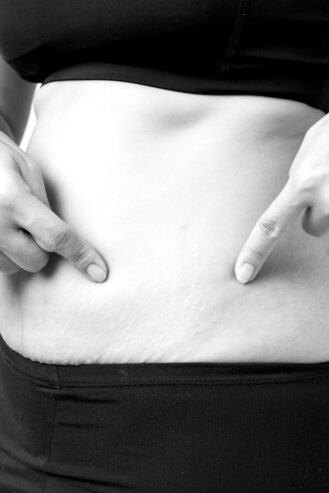 Non-Surgical Fat Dissolving Treatment in London – Target Stu